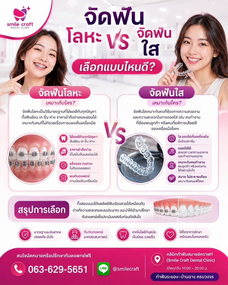 จัดฟันโลหะ vs จัดฟันใส เลือกแบบไหนดี